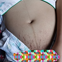 大家剖腹产多久妊娠纹开始变淡的呢？希望我的刀疤和妊娠纹能淡一点，再淡一点