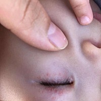 用米茶膏也不行 用百多邦也不行 都快一个月了  不停的在长  有宝妈知道的吗