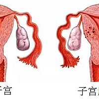 腺肌病不治疗，疼痛会越来越严重，贫血也会越来越重，子宫会逐渐增大甚至像怀孕一样，可能会压迫膀胱、...
