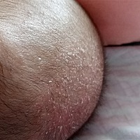 宝宝有头皮屑，怎么办