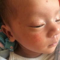 宝宝脸上这俩天长这些东西不知道是不是上火了？混合喂养