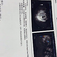 备孕了3个月，还不容易迎来新的生命，我心脏真受不了，我的俩个女孩子，这个肯定不能要了，只能说对不起...