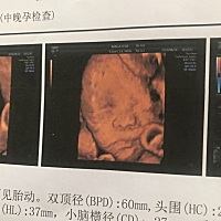 四维不像系列 真的是个吞金兽！36➕5提前破水、没有宫缩、打了三天缩宫针才开半指，第三天晚上发烧、顺...