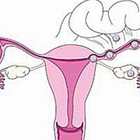 有些女性因为宫外孕，或是其他原因，切除了一侧输卵管或有一边是堵sai、nian连等情况。那么只有一侧通畅...