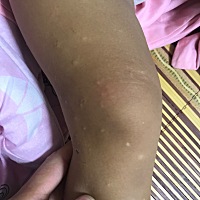 这是出的什么疙瘩呀，好长时间也不下去，真是头疼