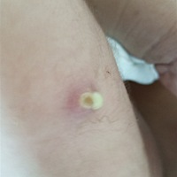 老三这个预防针伤口都一个多月了，还没愈合，刚刚帮他洗澡居然发现浓都流出来了。。。