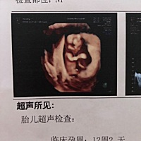 宝宝很可爱，第一次看的时候宝宝居然在站着睡觉，怎么也不醒，睡得贼香！没办法医生让我出去吃点东西，...