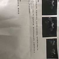 今天去医院第一次排卵监测去晚了医生说可能是排了也可能是没排，卵子老化，但是做B超的医生说是排出来了...