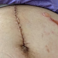 由于两胎不同家医院剖，二胎剖腹产后医生在伤口上帖了纱布和大胶带，我是比较敏感的皮肤，在胶带不透气...