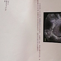 生完孩子那天做b超有盆腔积液，建议吃妇乐平吗