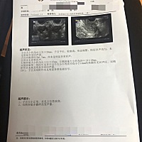 从第一次2018年底检查出一侧多囊没有在意，直到19年初开始试孕，一直没有任何结果，19年底医院检查两侧...