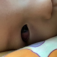 一周岁宝宝白眼底有大片红血丝，怎么办？