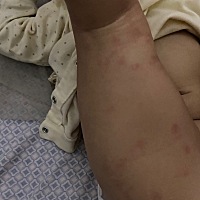 求助！！！各位宝妈们，你们知道宝宝腿上长的这些是什么吗？