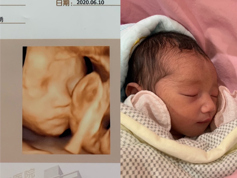 四维大排畸