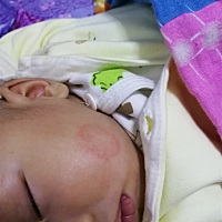 2个半月长个小米米，后来流黄水，再后来就这样一个印记？怎么办？可以搽什么药膏才能恢复？