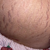我想问问各位宝妈们生了孩子后妊娠纹怎么祛除啊？有宝妈用过孕腹宝吗？效果怎么样？