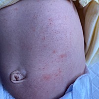 前一天去打了满月后的第一个预防针，第二天就这样结束！这是过敏还是湿疹引起的？最近饮食可能大鱼大肉...