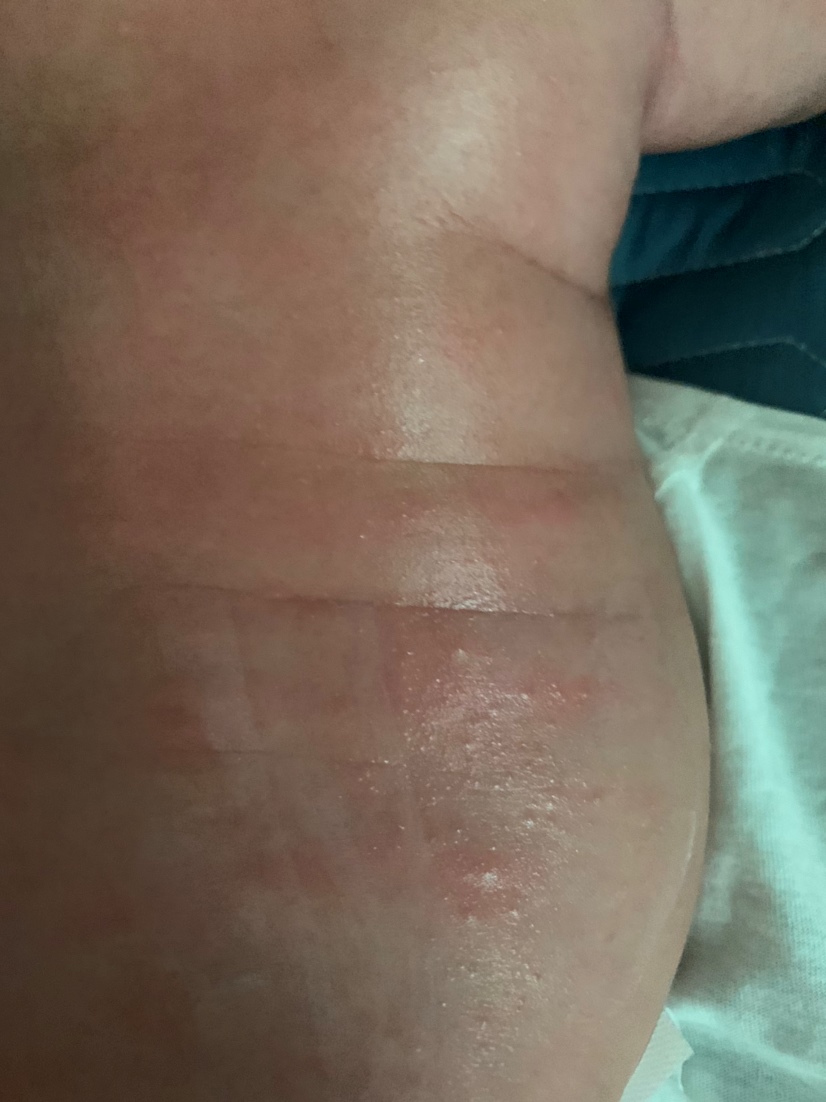 用了贝亲抚触油过敏了