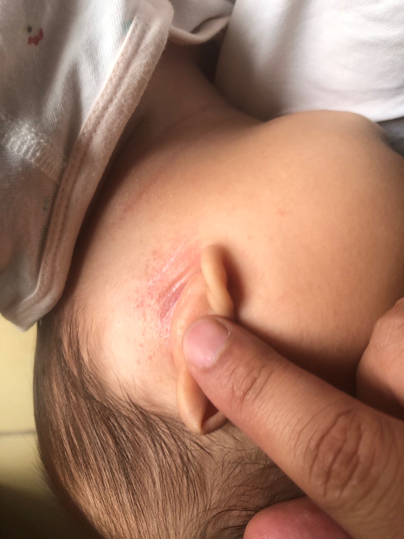 用了贝亲抚触油过敏了
