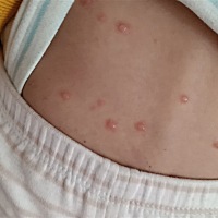 11个多月宝宝出水痘还发烧怎么办