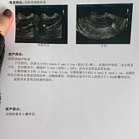 四个月没来月经了双卵巢多小囊样变性激素六项正常，医生说这个病和糖尿病一样。医生让吃孕酮。是不是中...