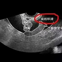 问：盆腔积液影响生育吗？很多人都有，一般不影响。生理性盆腔积液可以自行吸收。病理性积液，炎症引起...