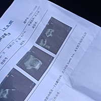 什么情况两次的B超单都是这个样子，怎么回事有知道的吗