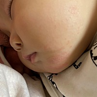 口水疹或者奶藓吗？