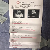 24周四维的时候拍出胎盘血窦  医生说  这个容易胎盘剥落早脱  导致大出血 要我多加注意  后面我就隔三差...