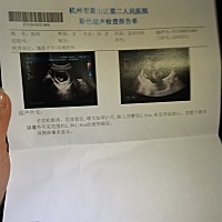 昨天不舒服，去医院发现胎停🏥 半夜自动就掉了，很是不舍，却又不无能为力！