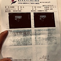 70天去南京儿童医院检查发现髋关节发育不良，让回家吊吊带..