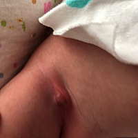 宝宝白14天大腿内侧起了这么大一个疙瘩，有知道是怎么回事的吗，谢谢大家了