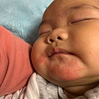 有哪位宝妈知道宝宝下巴红疹用什么好得快，看着宝宝下巴一天天红起来心里好着急