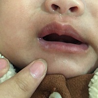 宝宝嘴唇上长的这个白斑点是什么