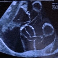 在正常情况下孕妇会在孕18-20周感受到胎动，刚开始还是比较轻微的胎动，而随着时间的推移，胎动会越来越...