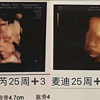 一胎女宝（四维检测时知道）整个孕期吐3次  女宝胎动整体次数少，集中晚上动的多，幅度较大，用宫缩式鼓...