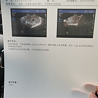 测到了怀孕一直担忧，今天终于做了阴超，给医生看，医生说不太好，有看的懂得小伙伴能告知一下这是为什么