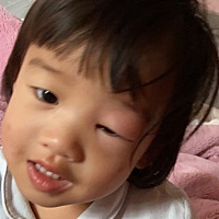 前天带出去玩时候不知道被啥虫虫还是蚊子叮了，然后这两天越来越肿，昨天带着看了医生开了一个抗过敏的...