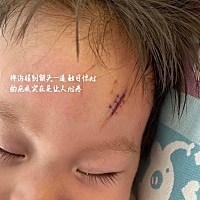 😩上个月孩子自己在家玩的时候不小心磕到家里的榻榻米，当时孩子哭的很大声，血也一直流，甚至流到眼...