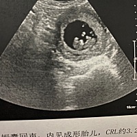 大姨妈前三四天测出的怀孕 双杠特别明显 35天左右开始孕吐 42天测出的胎心胎芽  孕囊特别圆 像个球一样...