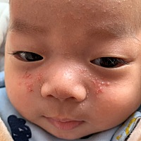 不知道宝宝脸上这个是什么，反正不是湿疹，湿疹膏没用，有没有跟我家一样的，要不要去医院看看，不想听...