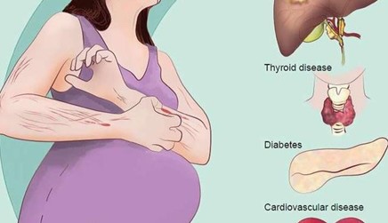 4、孕期高血糖
孕期出现血糖高，甚至是孕期患有妊娠糖尿病的宝妈，都会有不同程度的皮肤瘙痒现象，这是因为血液糖分高，霉菌容易入侵感染皮肤，糖尿病人出汗少，也会出现皮肤瘙痒干燥的情况，所以孕期血糖高的孕妈妈尤其要控制血糖，不要吃得过甜，尤其是蛋糕和水果，要控制食量，不可以贪嘴。
5、孕期免疫力差
孕期宝妈免疫力差，更容易被各种过敏原、微生物盯上，皮肤就会很容易出现问题。所以，孕期皮肤瘙痒一定要重视。
怀孕后，孕妈妈尽量选择棉质的衣服。孕晚期如果出现皮肤瘙痒的症状，孕妈妈要注意皮肤的保湿，可以选用一些保湿效果明显、适宜孕妈妈使用的护肤品，皮肤瘙痒发作时，孕妈妈不要用力抓挠，以免损伤皮肤，造成皮肤感染。如果比较严重的话，建议就医哦！