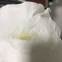 这个是啥。前天去检查。医生说这两天就会生。心里总是有点害怕