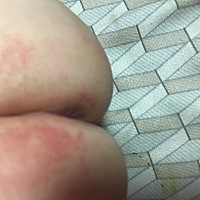 这几天一直在给宝宝涂红屁股的药，已经快要好了，突然这样了，有宝妈知道是怎么回事不