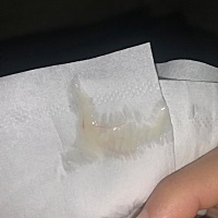 白带这样第四天了 血丝一天比一天多 不是chu 想知道这是怎么了上百度查全都是宫颈炎哭了