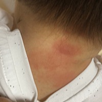 求助各位宝妈:我家宝宝一岁四个月，最近脖子后面红了好大一片，然后手上和脚不知道被什么咬了，好大一个...