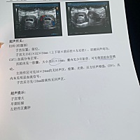 3.26最后一次来例假，至今48天。医生说胎囊形状不好，麻烦有经验的给看看呢