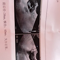 多囊卵巢综合症☹️☹️