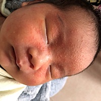 各位宝妈有知道宝宝脸上起的是什么吗？是湿疹吗？宝宝才22天，起三四天了，脸上越来越严重，不知道怎么...