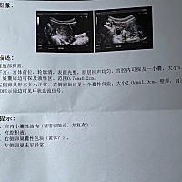 医生说还不能排除宫外孕，叫我十天后复查，心慌😭